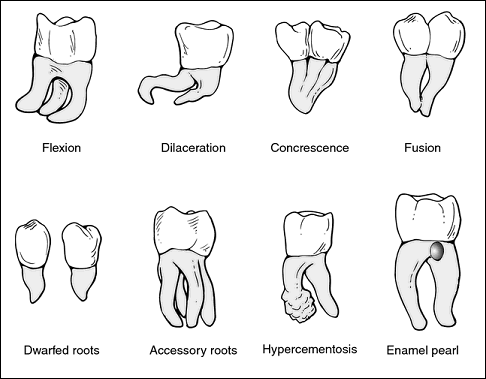 Variations in tooth roots