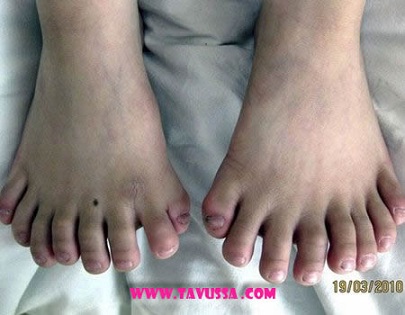 eight toed person