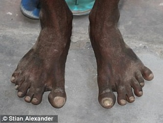 six toed person